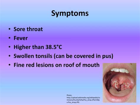 throatpie wiki|Streptococcal pharyngitis .